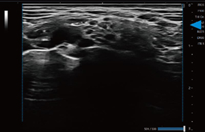 ≪深度：浅い≫台形走査OFF