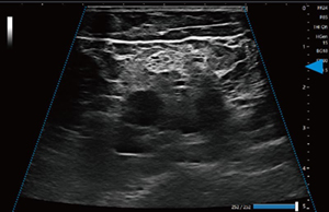 ≪深度：深い≫台形走査ON