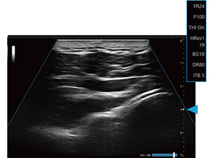 ≪深度：深い≫台形走査ON