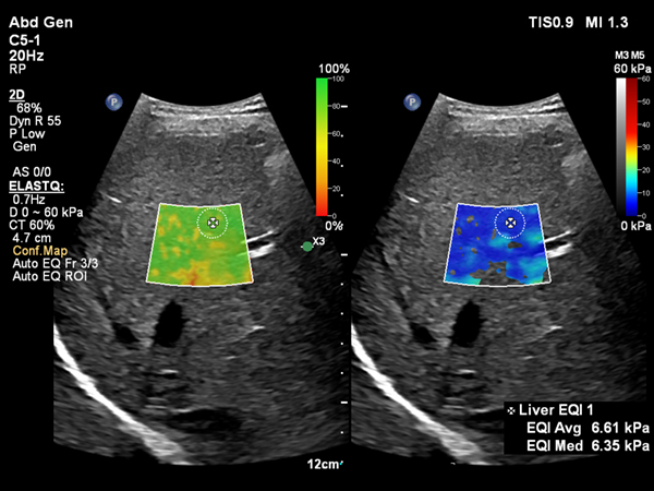 肝硬度測定ElastQの自動化機能搭載