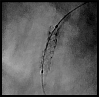 Imaging Excellence - よりクリアなステント像を提供 CLEARstent