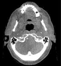 Metal Artifact Reductionの導入