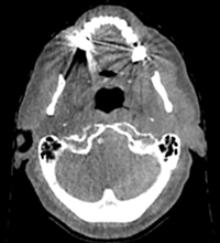 Metal Artifact Reductionの導入