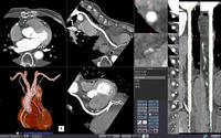 5）CT冠動脈バイパス解析