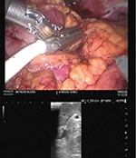 図2　腫瘍の位置確認とマーキング