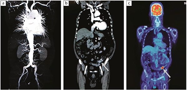 図1　想定外の病変が見つかった症例 大動脈瘤精査の症例でCTアンギオグラフィが撮影された（a）。冠状断で下行結腸に濃染があり，結腸がんが疑われた（b）。後日行われたFDG-PET/CTで腫瘍に集積があった（c）。