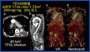 図1　造影剤減量CT angiography