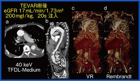 図1　造影剤減量CT angiography