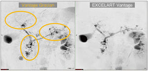 図1　多発分枝型IPMN患者における2D-MRCP