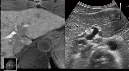 EOB-MRIを用いたRVS画像 Bモードでは不明瞭な胆管の走行が把握可能となる。