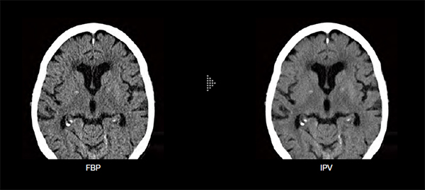 頭部画像のFBP（左）とIPV（右）の比較