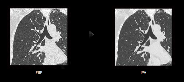 胸部画像のFBP（左）とIPV（右）の比較