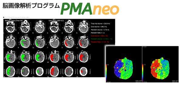 急性期脳梗塞治療に貢献する脳画像解析プログラム「PMAneo」