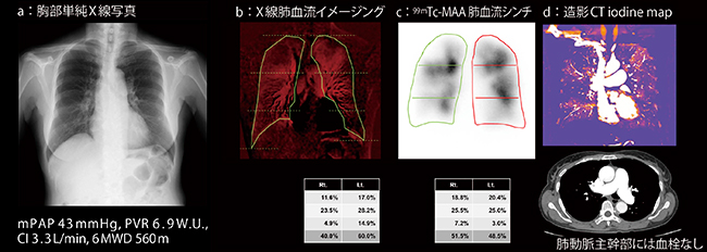 図4　症例1：慢性血栓塞栓性肺高血圧症（CTEPH） （ご提供：九州大学病院　※現在臨床研究下における症例画像）