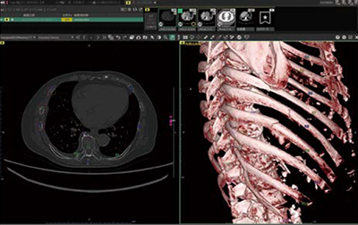 図2　肋骨骨折検出プログラムの利用例。脊椎・肋骨ラベリング，VR表示機能を併用できる。