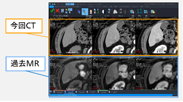 MRIとCTの画像でも自動レジストレーションが使用できる。