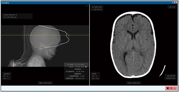 図1　小児頭部SSDE解析表示 （青色：CTDIvol，黄色：SSDE） 位置決め画像上でカーソルを移動させることで，任意のスライス位置でのSSDE値を表示可能。