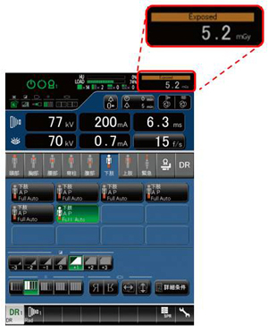 NDD法による被ばく線量管理