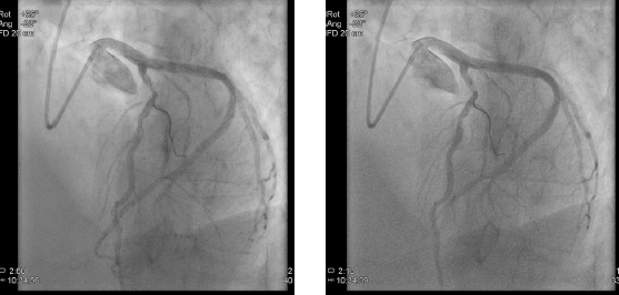 BMI 32の72歳の患者さんの冠動脈造影。マイン タウヌス心臓センターが同条件で撮影。