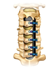 図2：頚椎椎弓形成術（片開き式椎弓形成術）における使用例