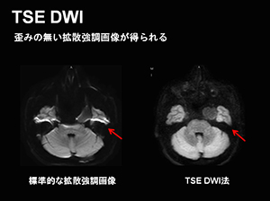 図1: 新DWI法「TSE DWI」で撮影した頭部画像