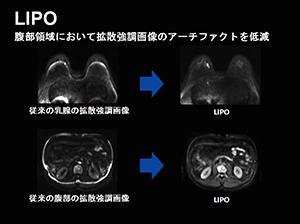 図2: 新DWI法「LIPO」で撮影した乳腺，腹部画像