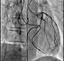 左冠動脈造影画像 ※ノイズが少なく明瞭なコントラストで血管が造影される。