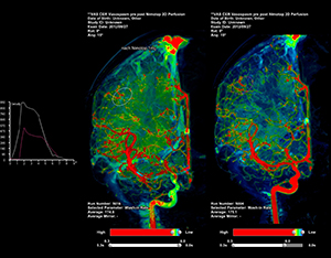 2D Perfusion 術前術後，左右の潅流状態を比較評価可能