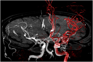 MR/CT 3Dロードマッピング