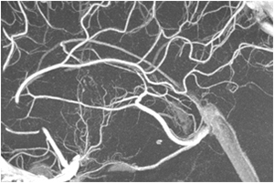 VasoCT - 穿通枝レベルの微細な血管を描出