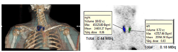 Q.Metrixによる結果画像（副甲状腺SPECT/CT検査）