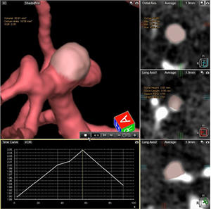 4D脳動脈形態計測