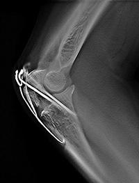 トモシンセシス画像 金属のアーチファクトが低減でき，骨折など金属固定している部分の経過観察に有用