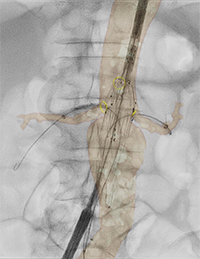 腹部大動脈瘤治療臨床症例1＊2