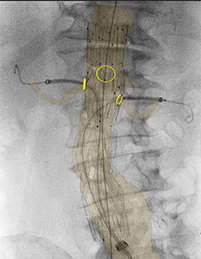 腹部大動脈瘤治療臨床症例2＊3
