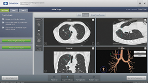 CT画像データを基に3D仮想気管支鏡画像生成。ターゲット病変部までの経路をプランニング