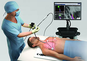 患者胸部を電磁場中に位置させ，気管支鏡のワーキングチャネルに磁器センサを備えたカテーテルを挿入。迷路のように分岐する肺末梢部でリアルタイムに位置を表示して，病変近傍まで正確に誘導