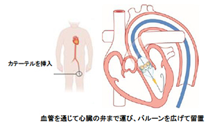 血管を通じて心臓の弁まで運び，バルーンを広げて留置
