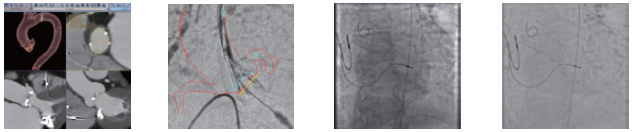 （左から）TAVI Analysis（プランニング用ソフトウェア），HeartVision2 （透視画像上に術前のCT画像をフュージョン。FOV，テーブルの位置，高さ，ガントリーの動きにすべて追従。プランの位置，血管形状，石灰化をそれぞれ表示可能），Calcification enhancement mode なし，Calcification enhancement mode あり
