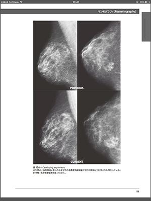 マンモグラフィ