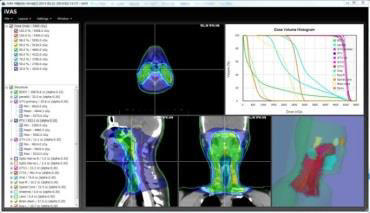 放射線治療計画支援システム『iVAS』