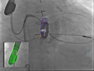 syngo TrueFusionの画像