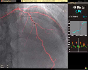 Courtesy from Dr. Eric Van Belle CHRU de