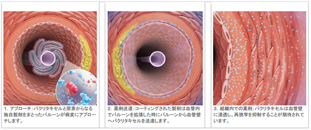 薬剤を病変に送達するメカニズムについて