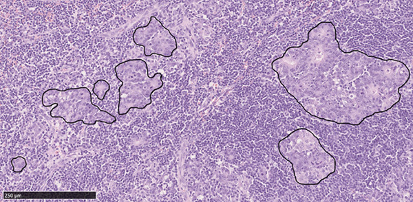 図1 胃がんのリンパ節転移（リンパ節のHE染色組織像：実線で囲まれた部分が転移組織）