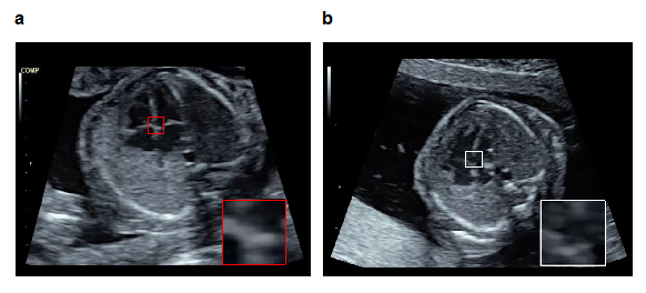 図1 物体検知技術を活用した胎児心室中隔の異常検知例 正常胎児心臓（a）において映っているべき心室中隔を提示し（赤枠），アノテーション済み教師データを用いて学習した物体検知技術を用いて，症例bにおいて実際に映っていた心室中隔の部位を検知する（白枠）。その相違から症例bは異常所見を有すると判定する（b. 心室中隔欠損）。