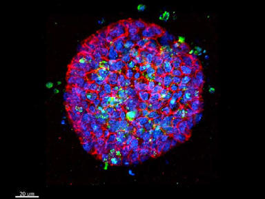 大腸がん患者から作成した細胞モデルの3次元解析結果 3次元細胞モデルに薬剤を投与。投薬後，死細胞が確認できる。（青:通常の細胞核，緑:死細胞）