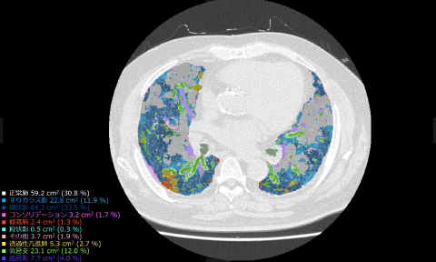 気管支，血管，正常肺および，網状影，すりガラス影，蜂巣肺など肺の7種類の病変性状を識別し，CT画像中の肺野内を自動で分類，定量化して表示する。