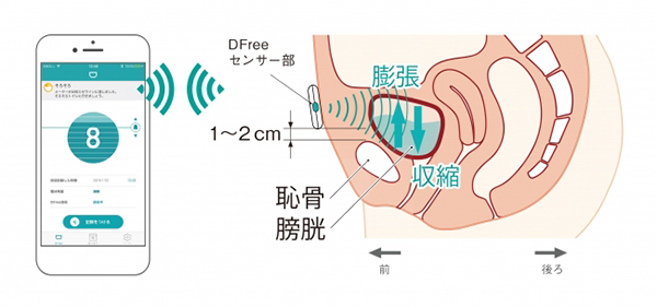 DFreeの仕組み： 下腹部に装着した本体の超音波で膀胱の変化を捉え，携帯端末に知らせる。