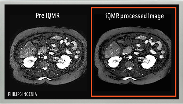 MRI撮影画像　（右）iQMR導入前　（左）iQMR導入後